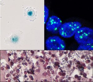 Caratteristiche morfologiche e molecolari di cellule di melanoma senescenti