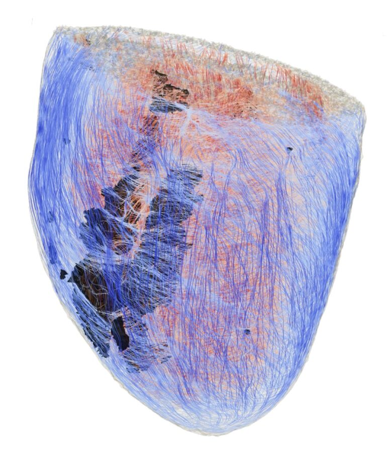 Ricostruzione digitale ad alta risoluzione della struttura cardiaca (la parte nera raffigura la fibrosi)